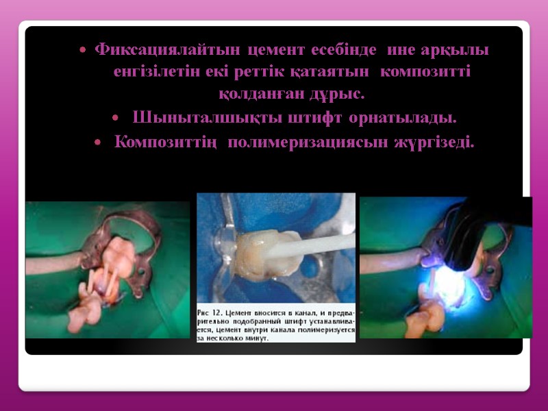 Фиксациялайтын цемент есебінде  ине арқылы енгізілетін екі реттік қатаятын  композитті қолданған дұрыс.